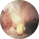 Iliopsoas Tendonitis